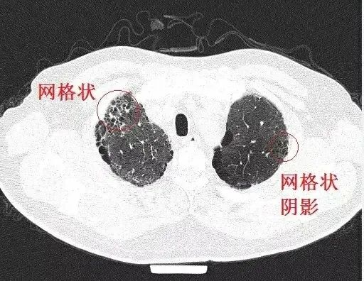 阿里健康首发石药集团抗纤维化药物伊络达® 为间质性肺病患者开辟院外新通道