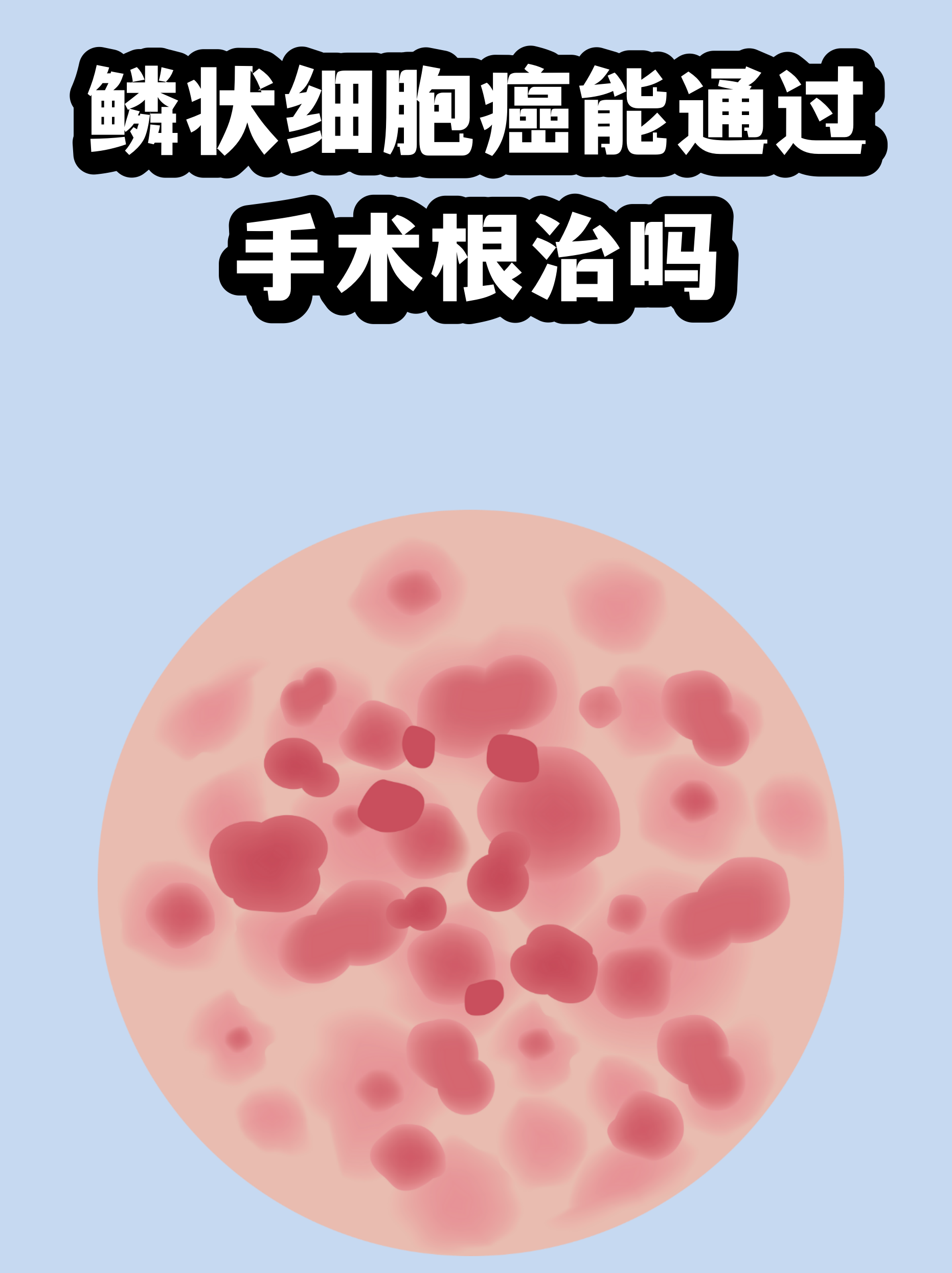 有些癌为何一确诊就是晚期？